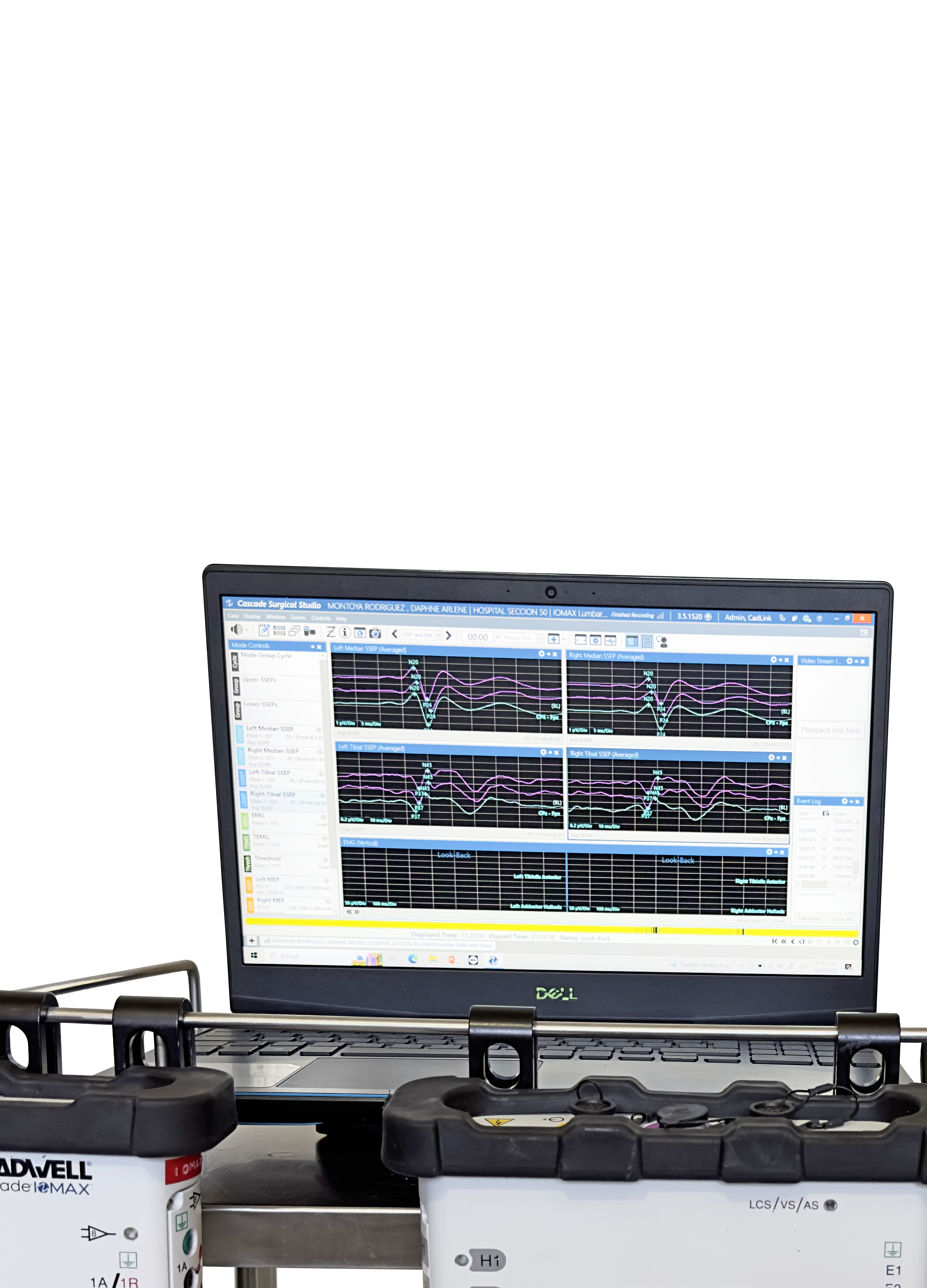 Intraoperative Neuromonitoring